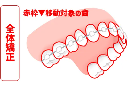 全体矯正で歯並びと咬み合わせを改善するイメージ