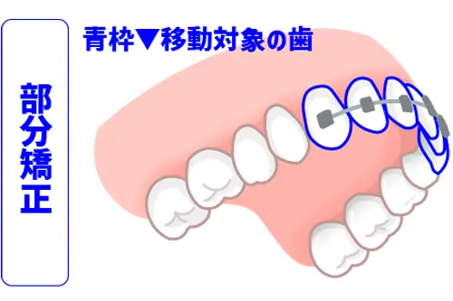 前歯だけを整える部分矯正のイメージ