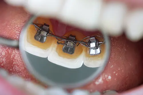 歯の裏側に装置を装着した裏側矯正のイメージ