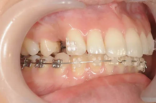 上顎は裏側・下顎は表側に装置をつけたハーフリンガル矯正のイメージ