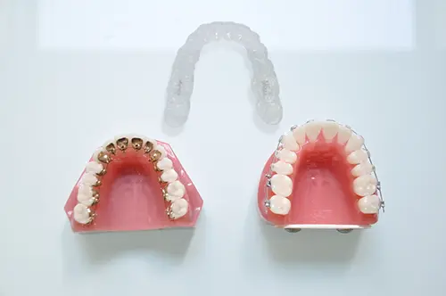 矯正装置の製作と装着のイメージ