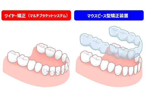 前歯だけを対象にした部分矯正のイメージ