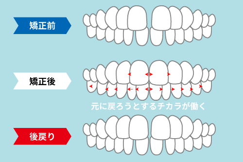 矯正後の後戻りのイメージ