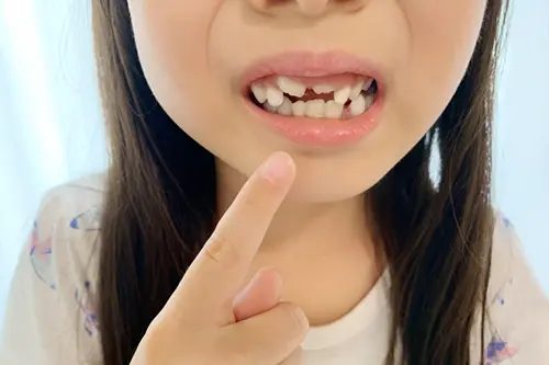 悪い歯並びの子ども