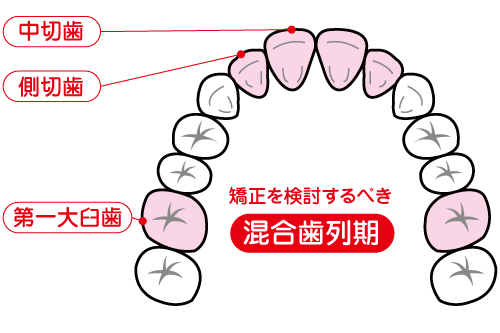 矯正を検討するべき混合歯列期