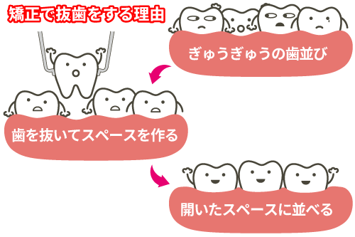 矯正で抜歯をする理由