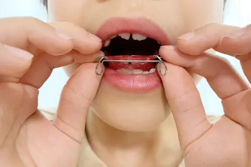 矯正装置を装着する子供