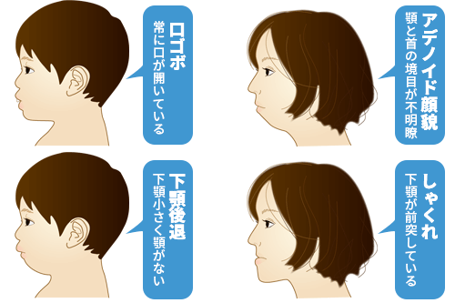 不正咬合が及ぼす顔貌への影響