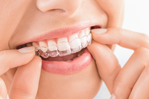 マウスピースを装着する患者