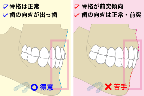 歯性上顎前突は得意で骨格性上顎前突は苦手を表したイラスト