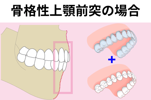 骨格性の出っ歯でワイヤー矯正を併用するケースの説明