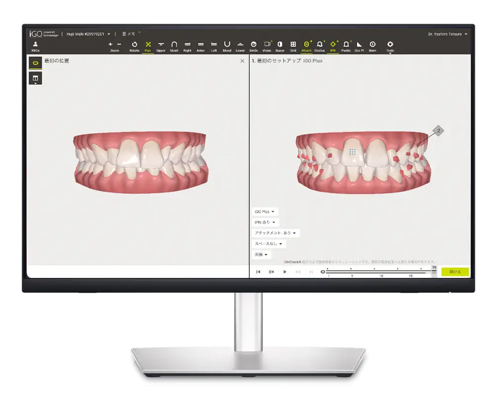 歯科医院で3Dスキャナーを用いた精密検査を行うイメージ