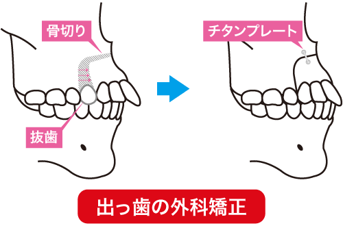 外科矯正で骨格から出っ歯を改善する治療のイメージ