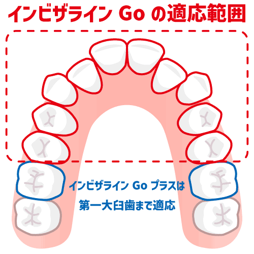 インビザラインGoの適応歯