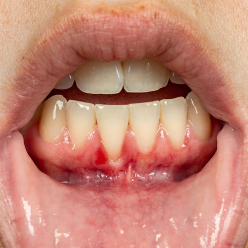 歯茎 の 腫れ 対処 法