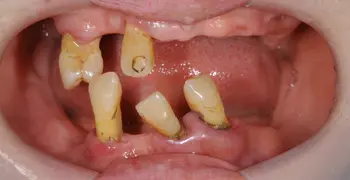 歯周病患者のフルマウス治療の症例写真