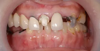 虫歯患者のフルマウス治療の症例写真