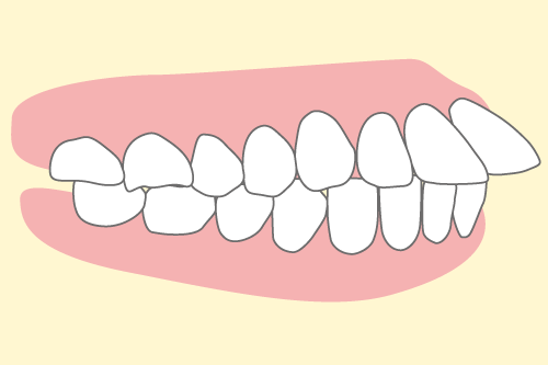 上顎前突のイラスト図解