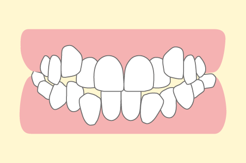 叢生のイラスト図解