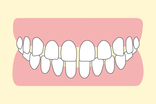 すきっ歯のイラスト図解