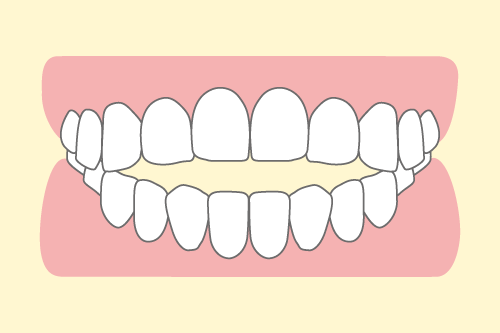 開咬のイラスト図解