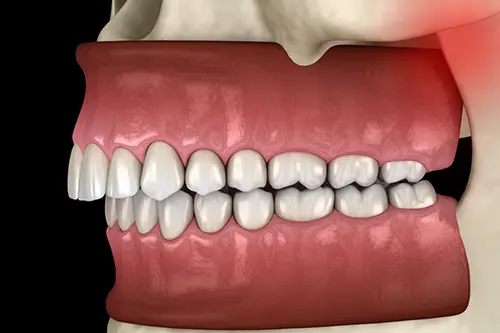 咬み合わせのずれが顎関節に負担をかけるイメージ