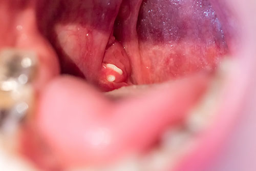 口臭の原因 臭い玉 膿栓 を取る方法 明石市の歯医者 明石アップル歯科