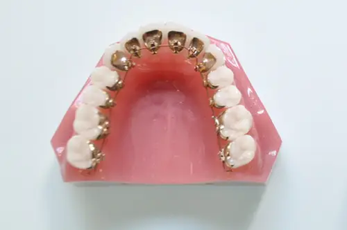 舌側矯正の模型