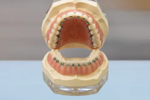 ハーフリンガル矯正の模型