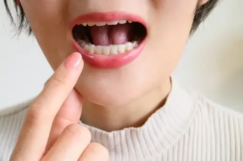 マウスピース矯正