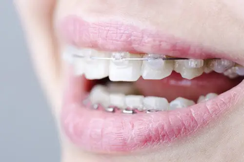 口を開けると目立つワイヤー矯正