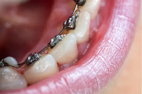 舌にあたる裏側矯正