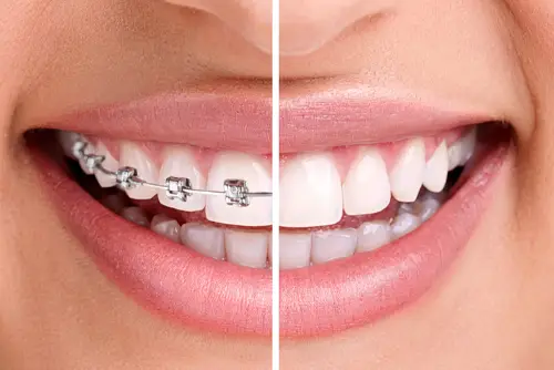 ワイヤー矯正と裏側矯正の見た目の違い