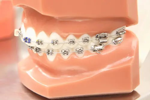 メタルブラケットの模型