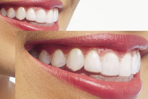 マウスピース矯正の目立たない口元