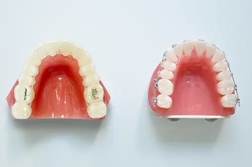 ワイヤー矯正とマウスピース矯正の見た目の違いを比較するイメージ