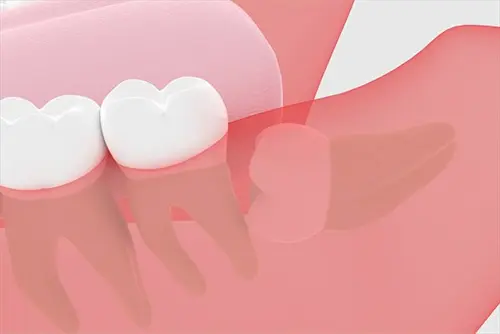 埋没した親知らずのイラスト