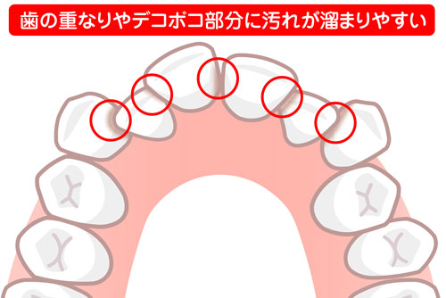 歯の重なりやデコボコ部分に汚れがたまりやすいイラスト