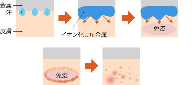 金属アレルギーが起きるメカニズム