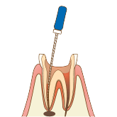 根管内の治療
