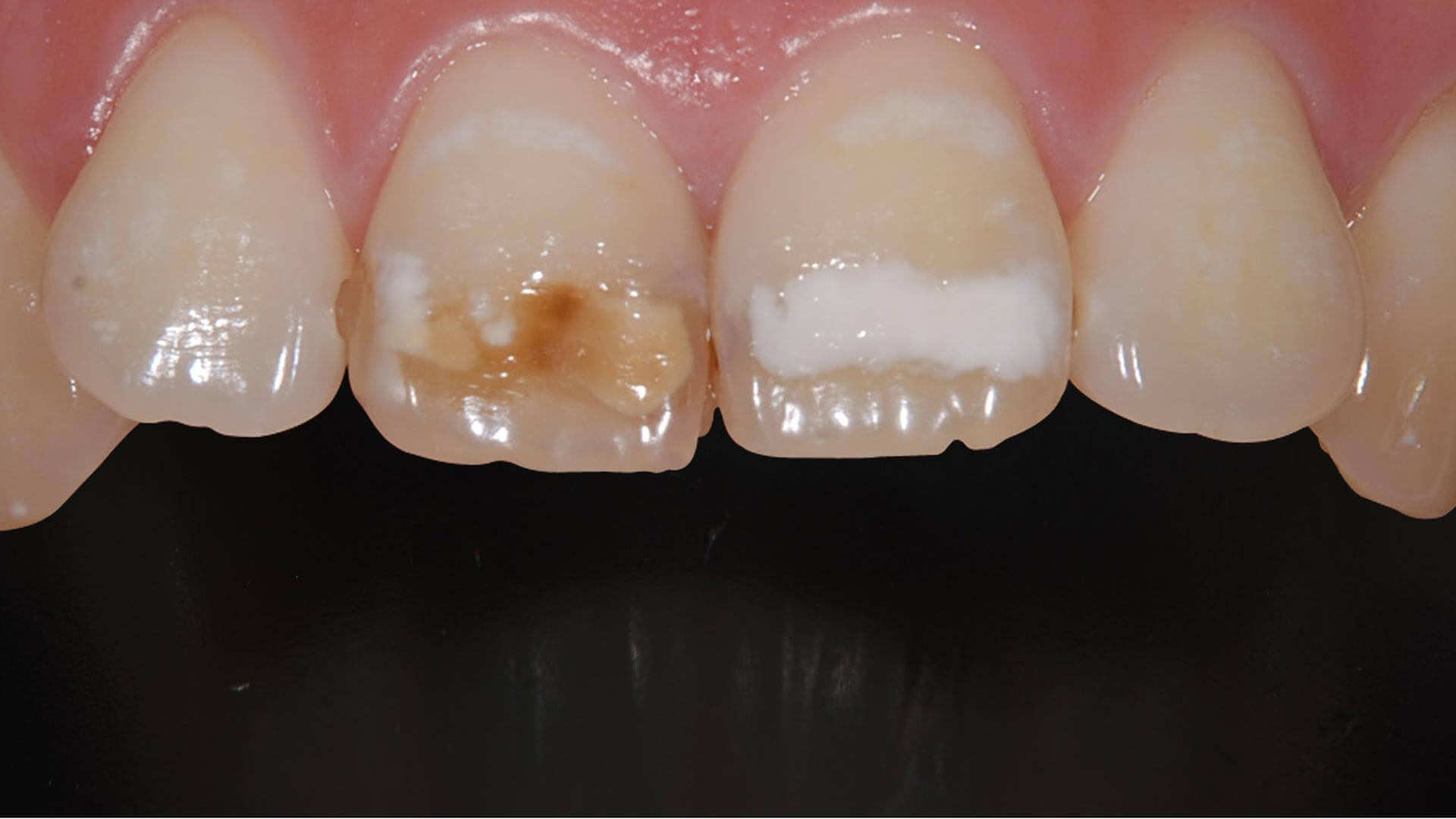 ホワイトスポット 歯の白い斑点は消えるの 明石アップル歯科
